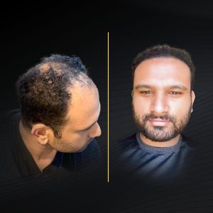 HT Before & After (1)