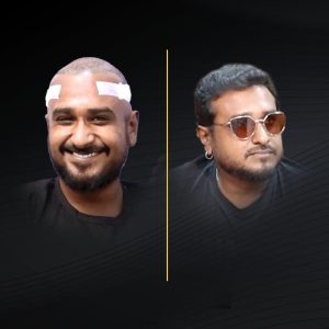 HT Before & After (2)