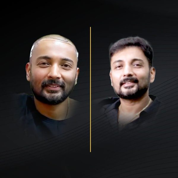 HT Before & After (3)